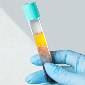 san diego naturopathic doctors clear vial of platelet rich plasma