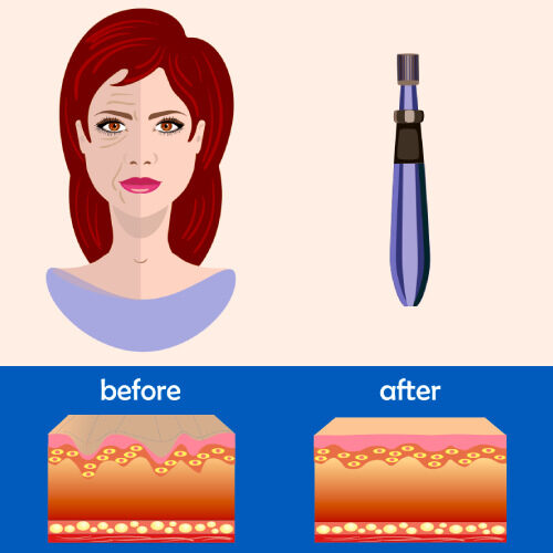 san diego naturopathic doctors collagen induction therapy skin health inforgraphic illustration