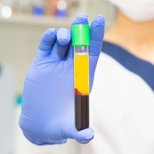 san diego naturopathic doctors healthcare worker holding single vial of prp