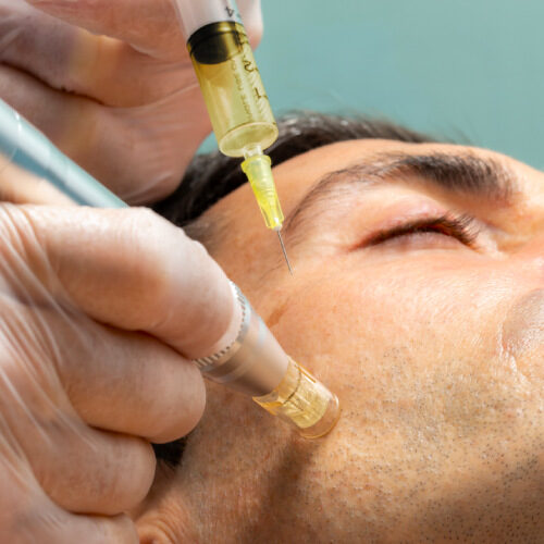 san diego naturopathic doctors microneedle pen operating on mans cheek skin